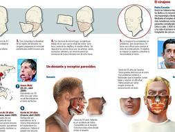 El trasplante de cara se hizo por debajo de los ojos hasta el maxilar inferior