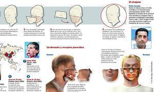 Primer trasplante de cara en Espa�a