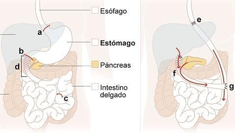 Perder el est�mago para adelantarse a un c�ncer