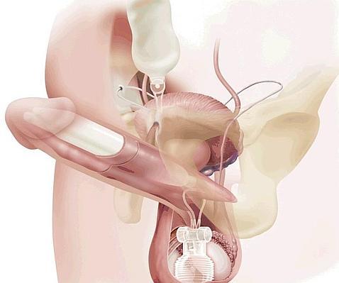 Si la viagra no funciona... pr�tesis de pene