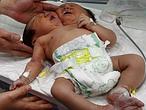 Un bebé con dos cabezas en China Un bebé con dos cabezas en China