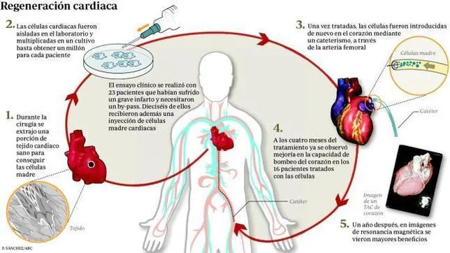 El corazn infartado puede repararse a s mismo con una inyeccin de clulas