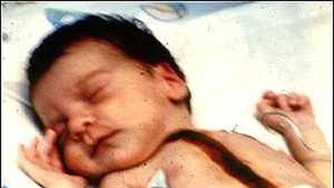 El fallido experimento con �Baby Fae�, la ni�a que vivi� 21 d�as con el coraz�n de un mono