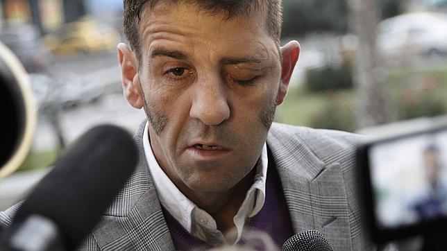 Reconstruyen el nervio facial de Padilla tras 11 horas de operación Reconstruyen el nervio facial de Padilla tras 11 horas de operación