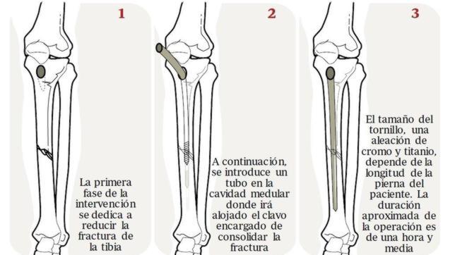 La Eurocopa de Villa empieza hoy La Eurocopa de Villa empieza hoy