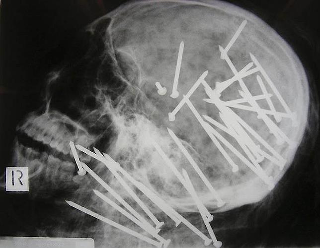 radiografia_craneo_clavos--644x500.jpg