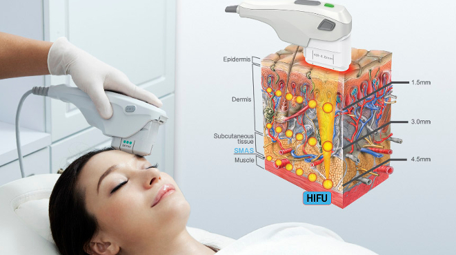 hifu mujer y explicacion