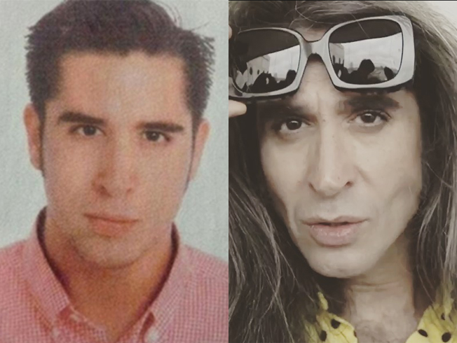 vaquerizo bichectomia