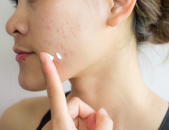 Acné y sol, cómo tratar la piel