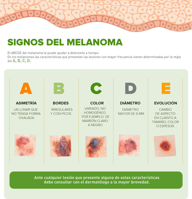 signos melanoma aecc