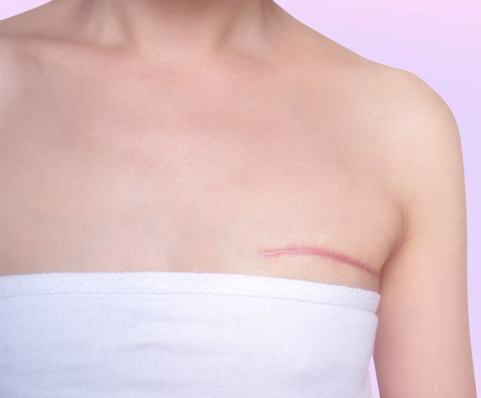 ganancia peso cancer mama