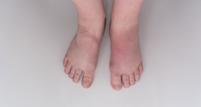 pies hinchados cancer mama