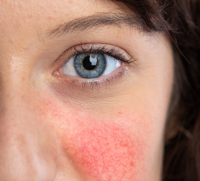 Qué son las rojeces de piel del rostro cómo de efectiva?