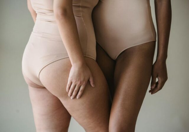 Qué es el lipedema, la enfermedad que engorda las piernas