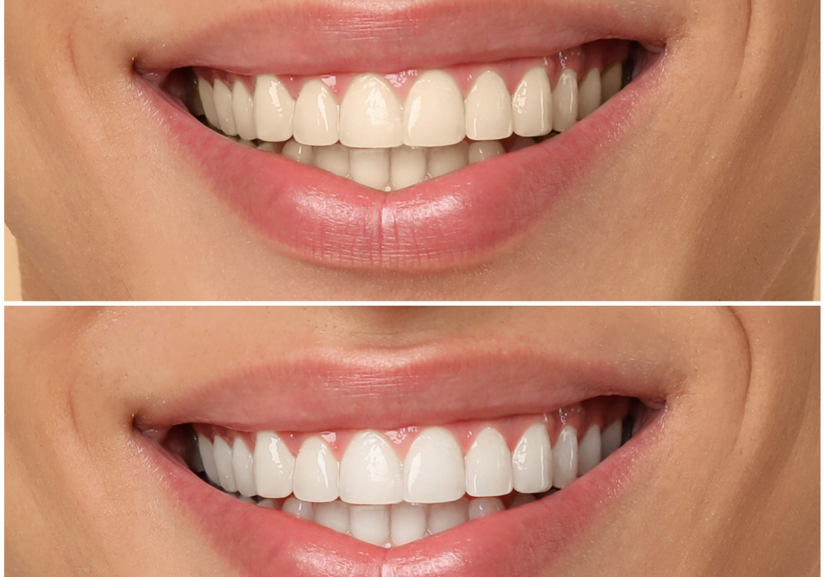 Los dentistas advierten sobre los blanqueamientos dentales ‘low cost’: “No todo el mundo es candidato”
