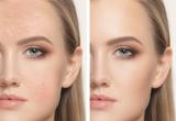 Las mejores bases de maquillaje para pieles con acn&eacute;
