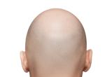 Por fin un f&aacute;rmaco eficaz para luchar contra la alopecia