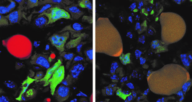 Las células cancerosas marcadas en verde y una célula grasa marcada en rojo en la superficie de un tumor (izquierda). Después del tratamiento (derecha), tres células cancerosas anteriores se han convertido en células grasas.
