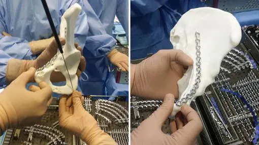 Utilización de huesos impresos en 3D en intervenciones en el hospital Virgen del Rocío